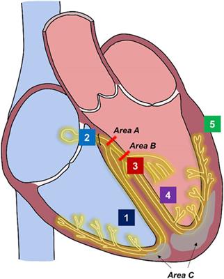 Cardiac resynchronization considerations in left bundle branch block